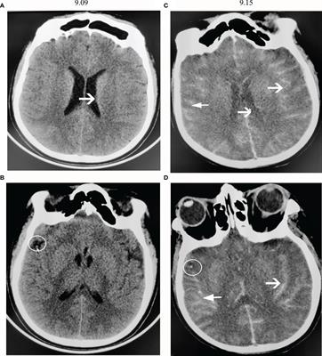 Case Report: Recognition of Devastating Primary Amoebic Meningoencephalitis (PAM) Caused by Naegleria fowleri: Another Case in South China Detected via Metagenomics Next-Generation Sequencing Combined With Microscopy and a Review